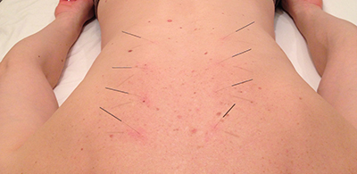 client receiving acupunture